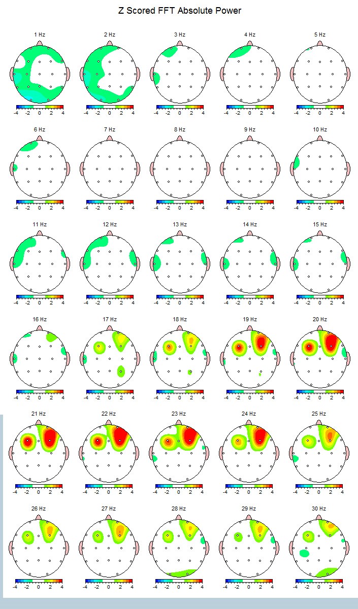 NeuroGuide maps comparison