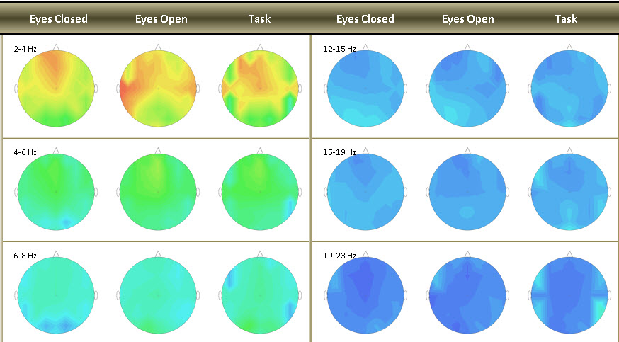 Autonomic Tone Issues - Cold Cingulate