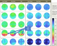 TQ Assessment brain pattern findings